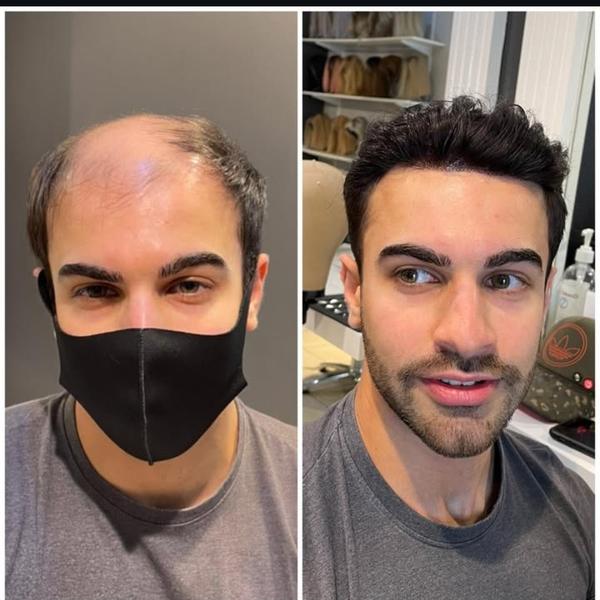 Miraj Hair Patch in Rohini Non