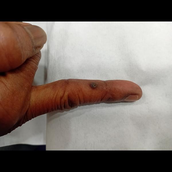 wart removal treatment trichy