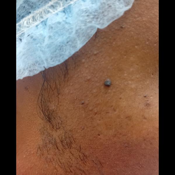 skin tag removal trichy vibha 