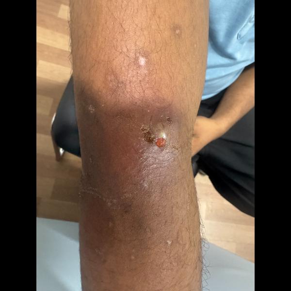 skin infection treatment trich