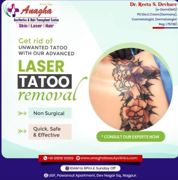 Laser Tattoo Removal uses high-intensity