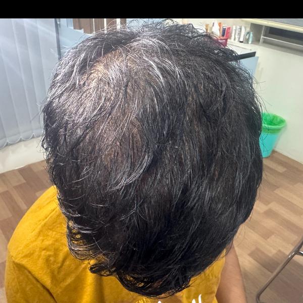 expert hair fall treatment in 
