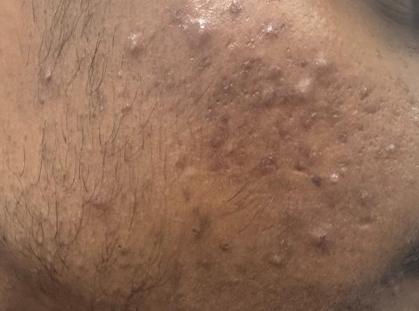 pimple treatment in trichy