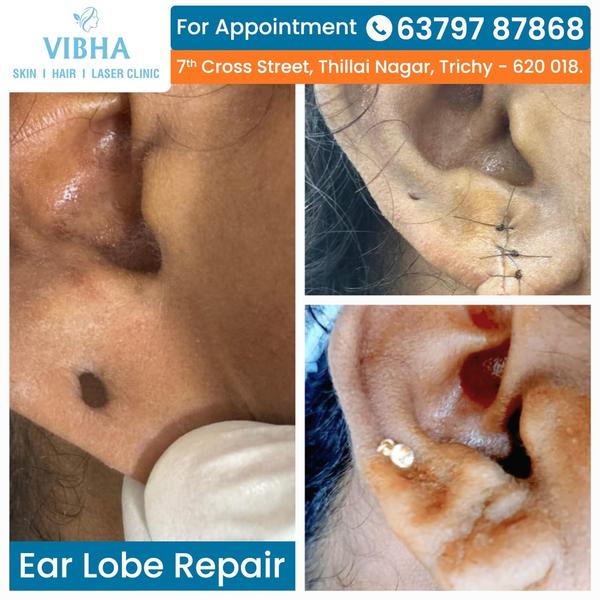 earlobe repair in trichy