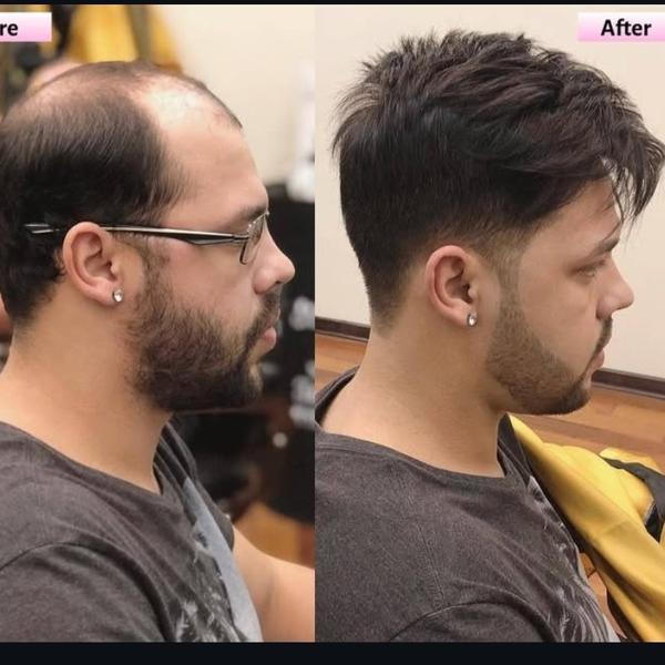 australian hair patch in rohin