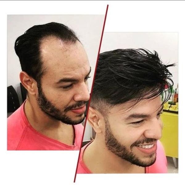 front less skin base hair patc