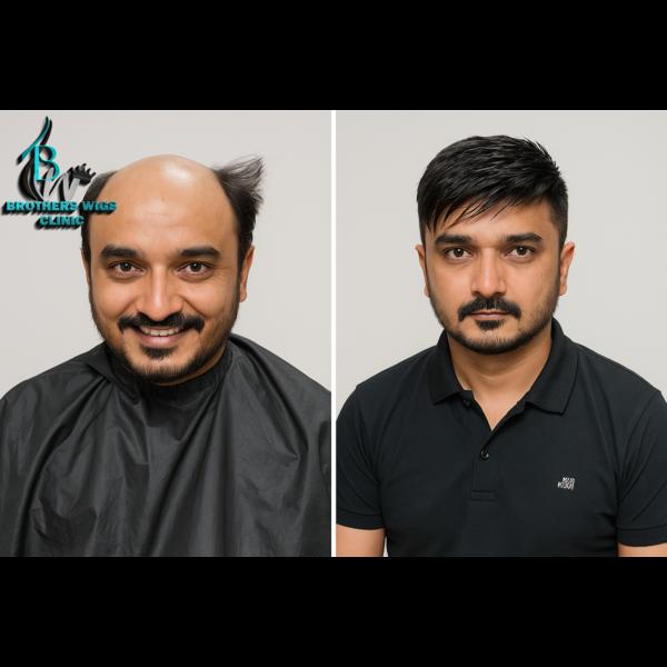 undetectable hair loss solutio