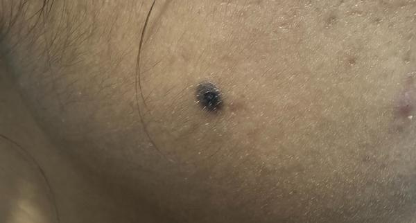 mole removal trichy dermatolog