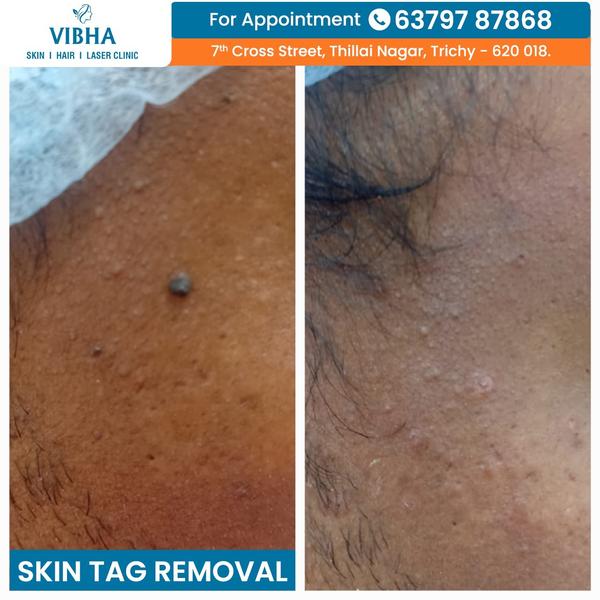 skin tag removal expert