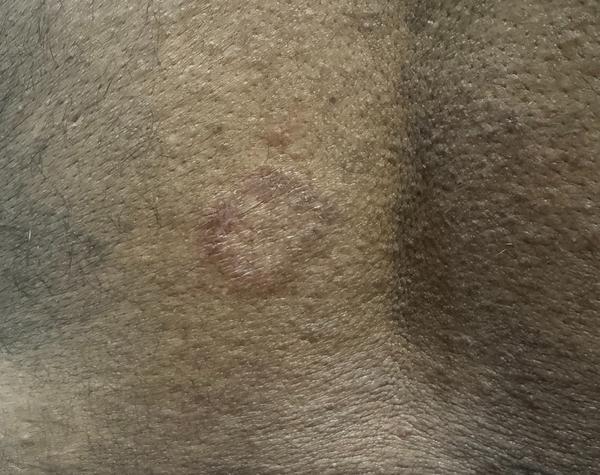 fungal infection treatment in 