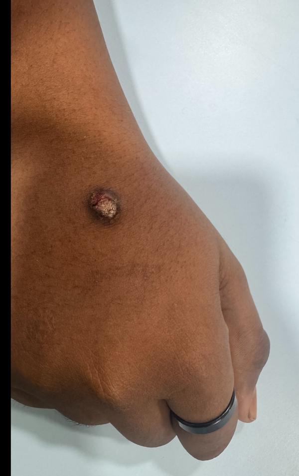 wart removal treatment thillai