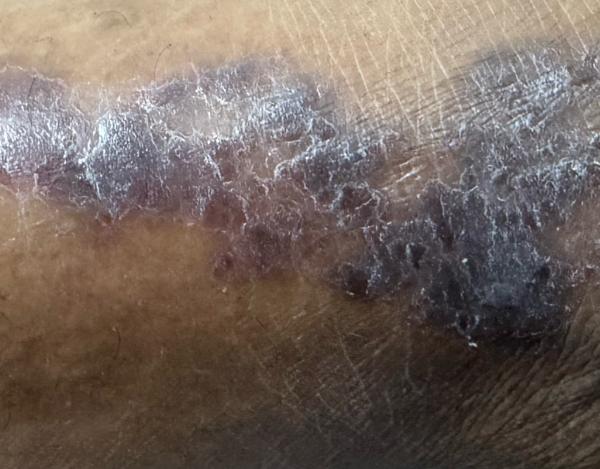 eczema treatment trichy