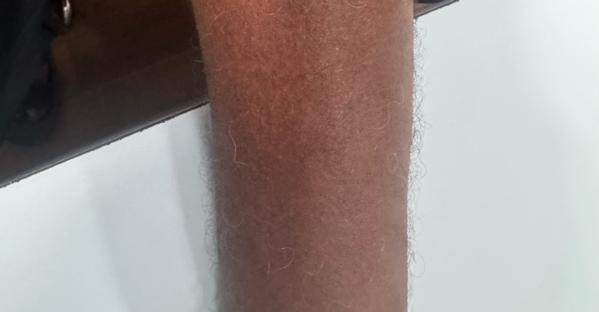 skin allergy treatment trichy