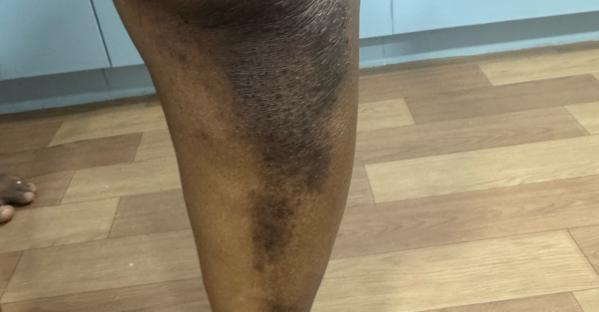 psoriasis treatment trichy