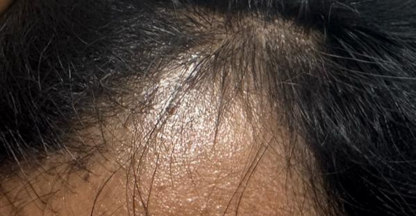 professional hair fall clinic 