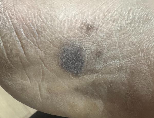 eczema treatment trichy