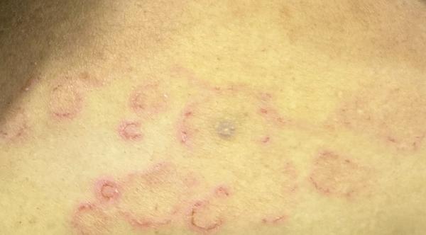 fungal infection doctor in thi