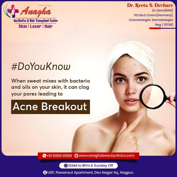 To treat an acne Breakout, begin with co