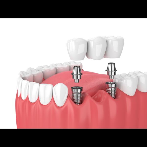 Looking for the best dental im