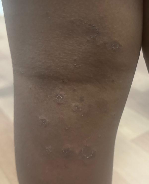 eczema treatment trichy