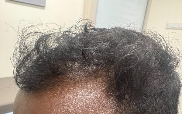 gfc treatment thillai nagar