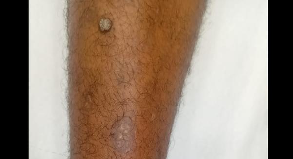 trichy skin doctor for wart re