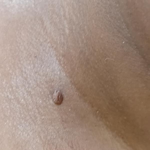 mole removal expert in trichy