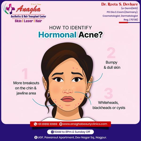 🧑‍⚕️* Harmonal Acne*🧑‍⚕️ Harmonal acne