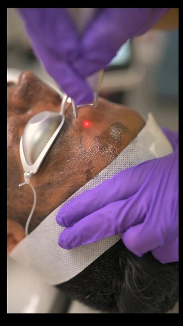 ✨ Carbon Peel: The Glow-Getter