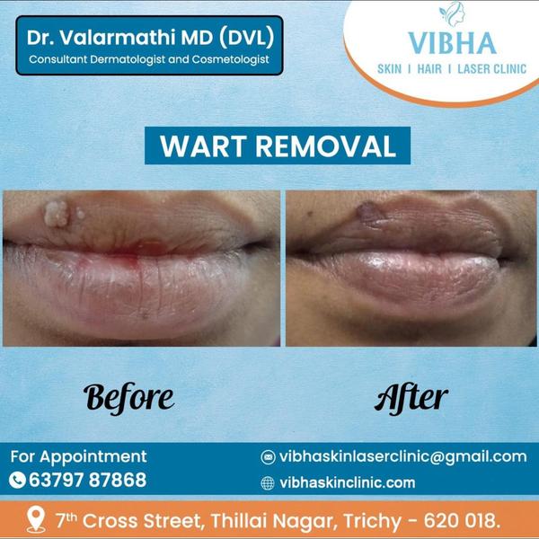 mole removal expert in trichy