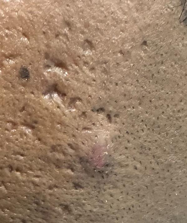 hypertrophic scar treatment in