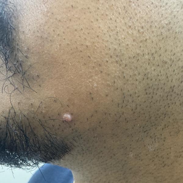 trichy skin doctor for wart re