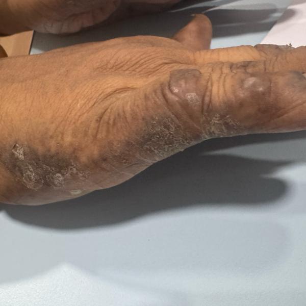 trichy psoriasis and eczema tr