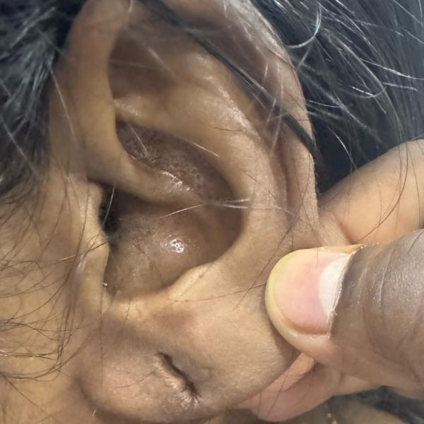 earlobe repair in trichy