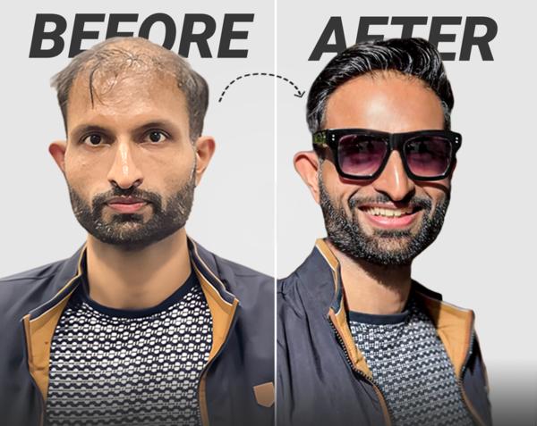 Hair patch in Rohini budget-fr