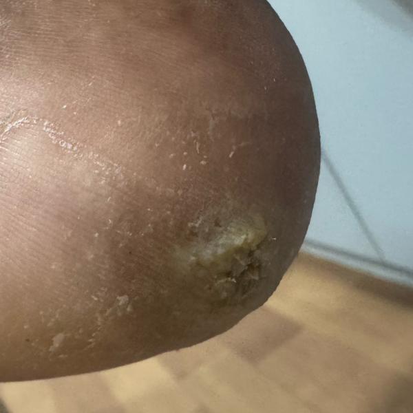 corn removal trichy vitiligo t