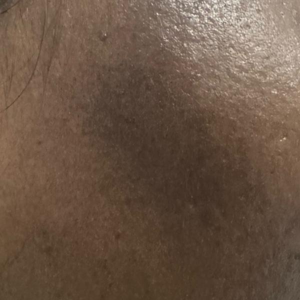 best acne treatment trichy