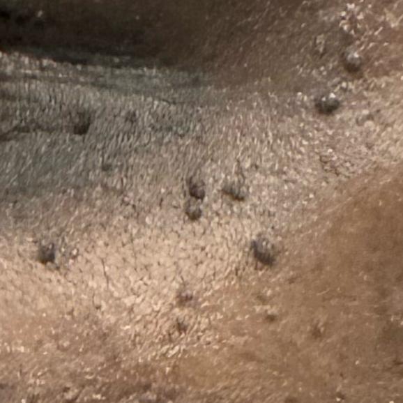affordable skin tag removal th
