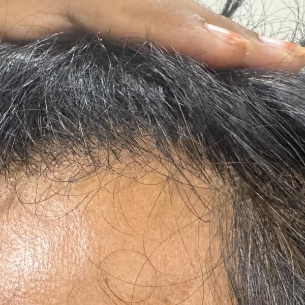 dermatologist for hair fall tr