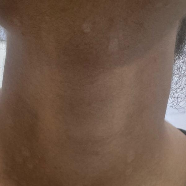 hydra facial in trichy