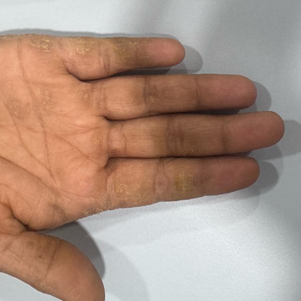 trichy psoriasis and eczema tr