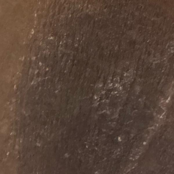 dandruff treatment expert tric