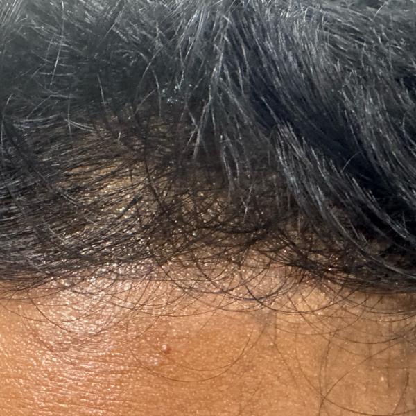 best hair fall treatment in tr