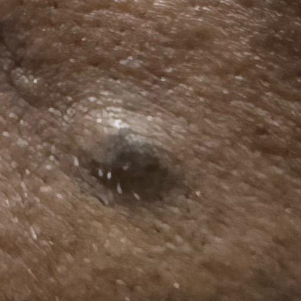 mole removal dermatologist tri