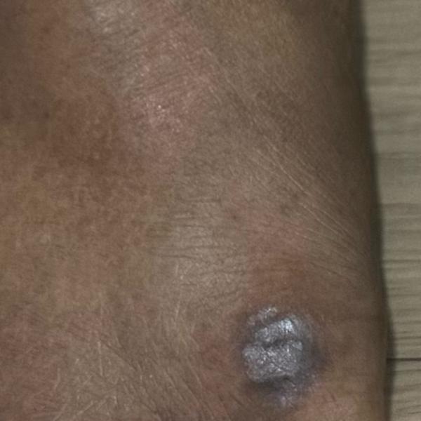 trichy psoriasis and eczema tr