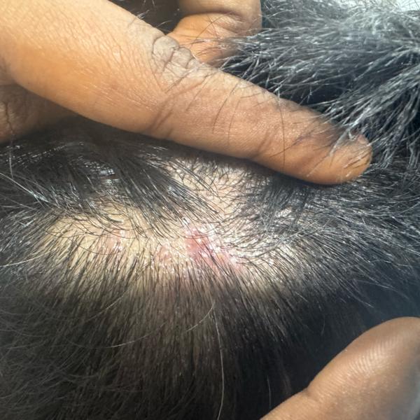 skin doctor trichy fungal infe