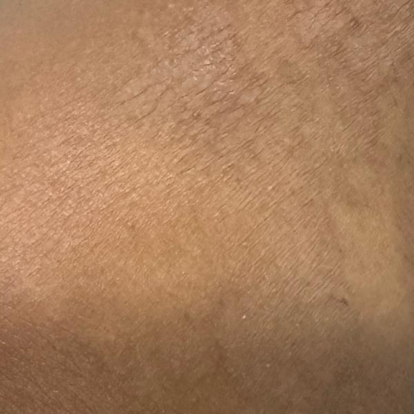 skin doctor trichy fungal infe