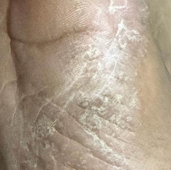 psoriasis treatment in trichy 