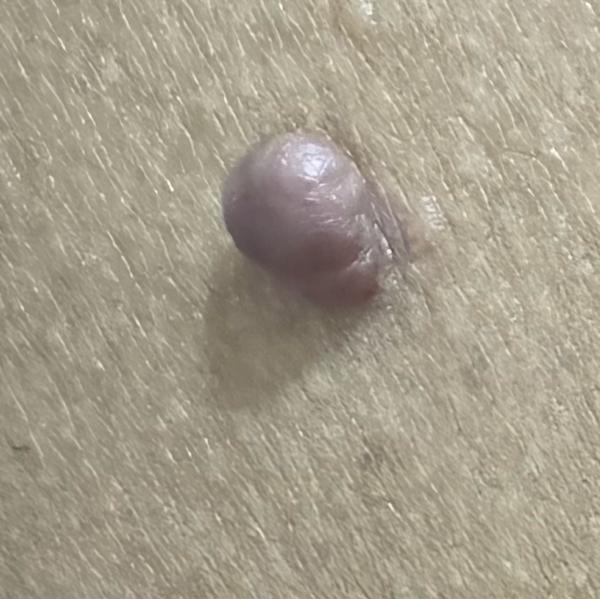 skin tag removal thillai nagar