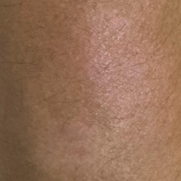 corn removal trichy vitiligo t